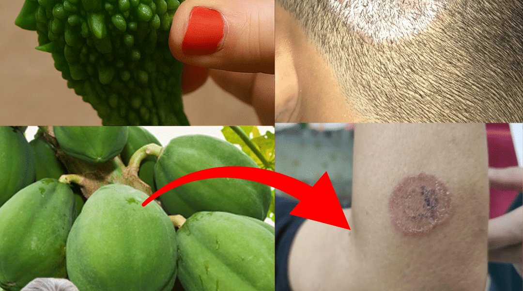 9 Ultimate Home Remedies to Eradicate Fungal Infections Fast and Naturally – dogpjs.com – Health