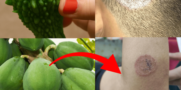 9 Ultimate Home Remedies to Eradicate Fungal Infections Fast and Naturally – dogpjs.com – Health