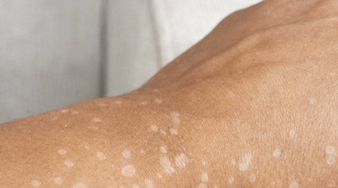 Have You Noticed Small White Spots on Your Arms or Legs? Here’s What You Need to Know About Them – Health