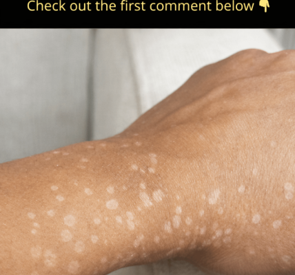 Have You Noticed Small White Spots on Your Arms or Legs? Here’s What You Need to Know About Them – Health