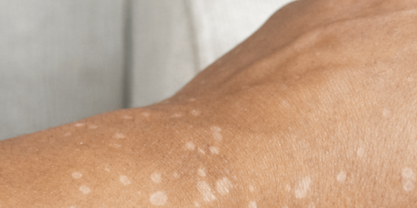Have You Noticed Small White Spots on Your Arms or Legs? Here’s What You Need to Know About Them – Health