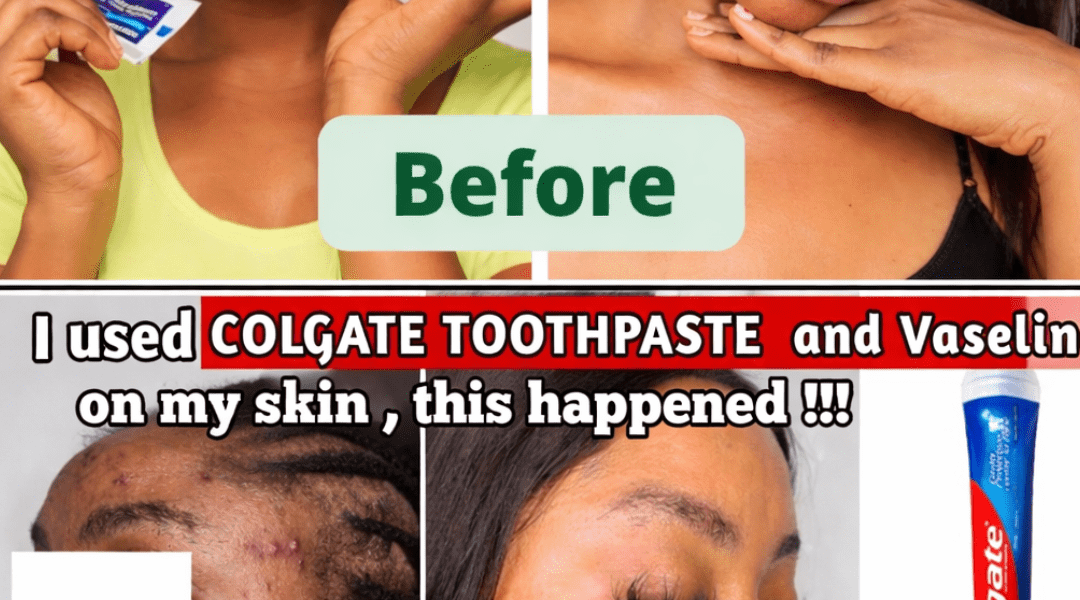 What Happens When You Apply Toothpaste and Vaseline to Your Face? A Closer Look at This Viral Trend – Health