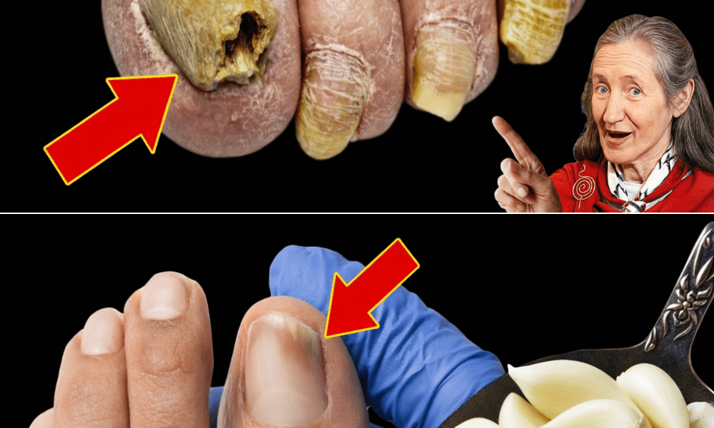 The Garlic Trick That Could Help Restore Your Toenail Health – Health