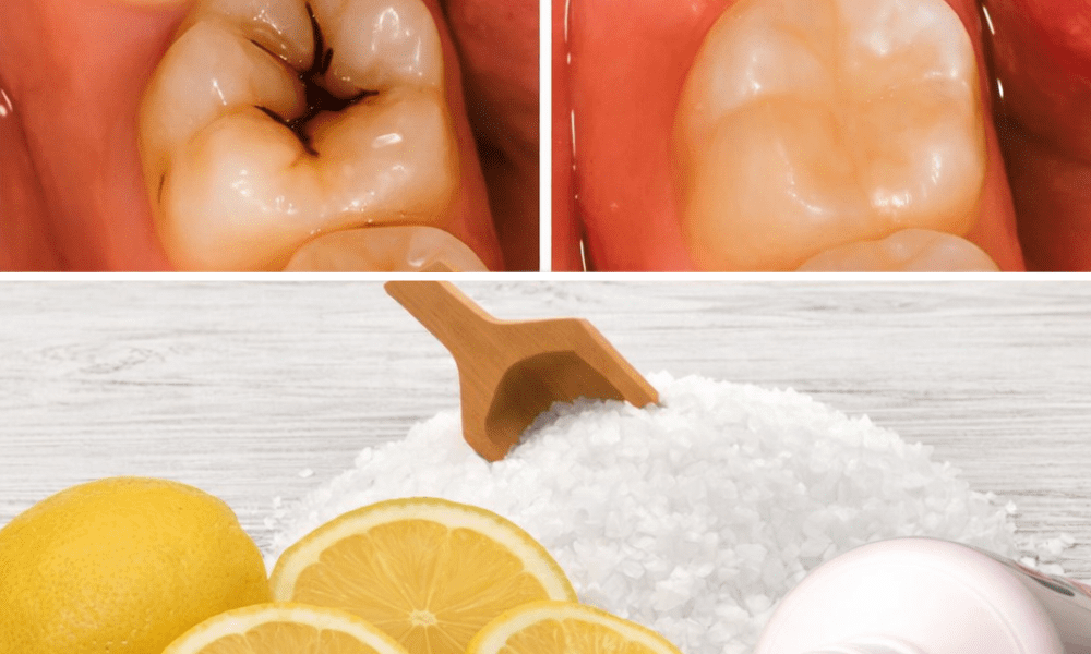 How to Naturally Repair a Cavity and Strengthen Your Teeth – Health