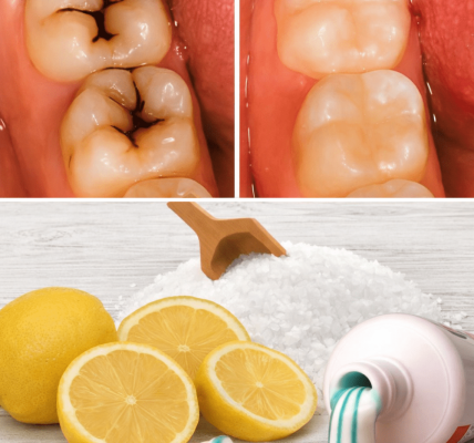 How to Naturally Repair a Cavity and Strengthen Your Teeth – Health