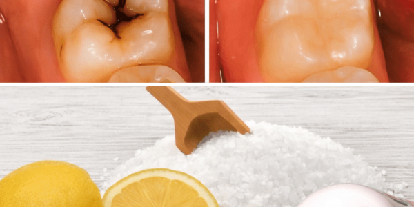 How to Naturally Repair a Cavity and Strengthen Your Teeth – Health