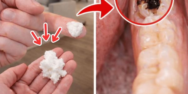 5 Powerful Home Remedies That May Help Prevent Cavities and Reduce Dental Visits – Health
