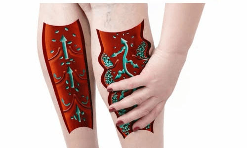 If You Have Poor Circulation, Cold Feet or Varicose Veins, Start Doing These 6 Things – Health