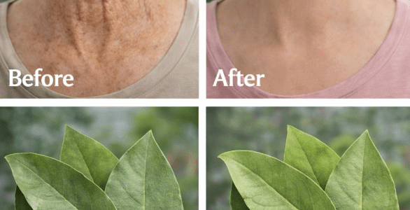 Is Bay Leaf “100,000x Stronger Than Botox” for Wrinkles? Here’s the Truth – Healthy Life