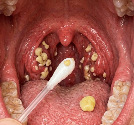 Is Persistent Bad Breath Ruining Your Confidence? Tonsil Stones Might Be the Hidden Culprit – Healthy Living!