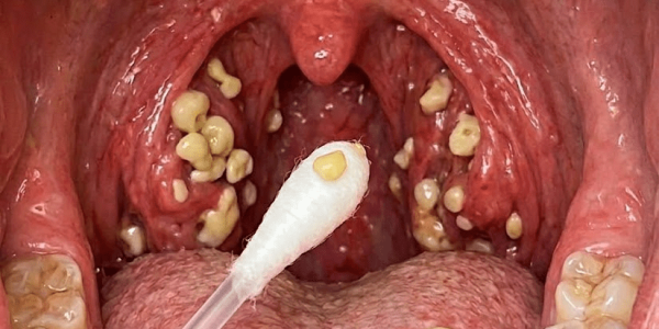 Is Persistent Bad Breath Ruining Your Confidence? Tonsil Stones Might Be the Hidden Culprit – Healthy Living!