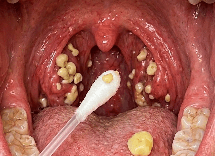 Is Persistent Bad Breath Ruining Your Confidence? Tonsil Stones Might Be the Hidden Culprit – Healthy Living!