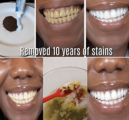 In Just 2 Minutes, Remove 10 Years of Teeth Stains – The Natural Whitener That Actually Works – Health