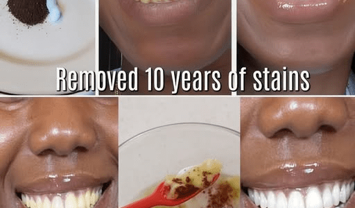 In Just 2 Minutes, Remove 10 Years of Teeth Stains – The Natural Whitener That Actually Works – Health