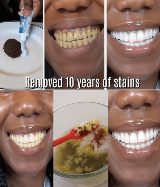 In Just 2 Minutes, Remove 10 Years of Teeth Stains – The Natural Whitener That Actually Works – Health