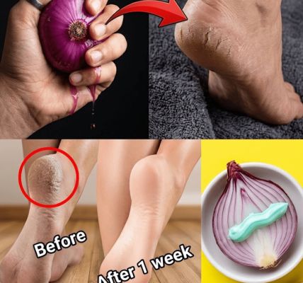 5 Natural Remedies That May Transform Cracked Heels – Healthy Life