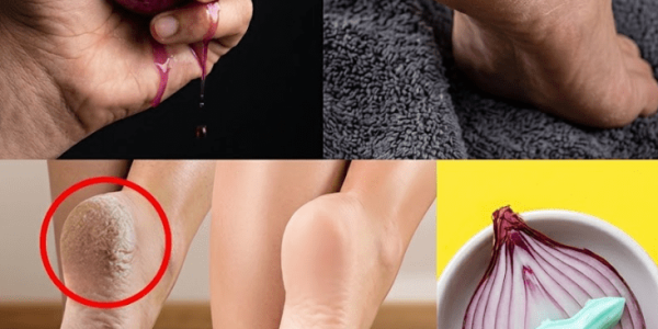 5 Natural Remedies That May Transform Cracked Heels – Healthy Life