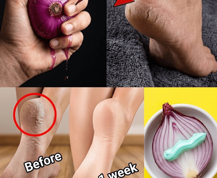 5 Natural Remedies That May Transform Cracked Heels – Healthy Life