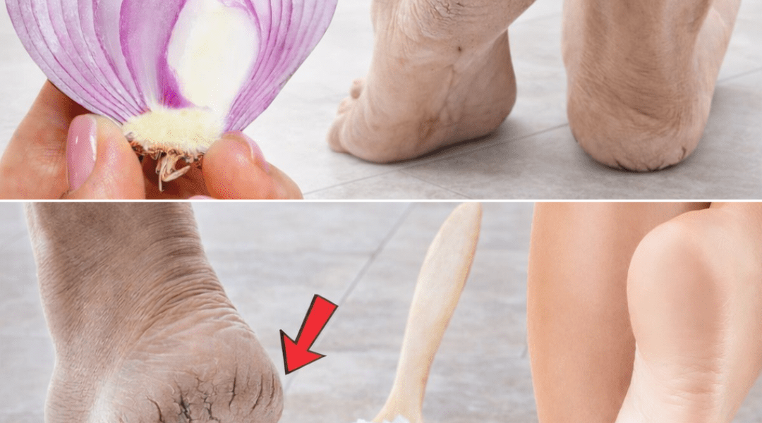 5 Natural Home Remedies for Cracked Heels (That Actually Work) – Health