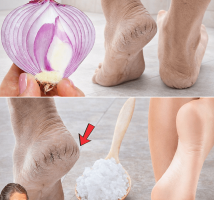 5 Natural Home Remedies for Cracked Heels (That Actually Work) – Health