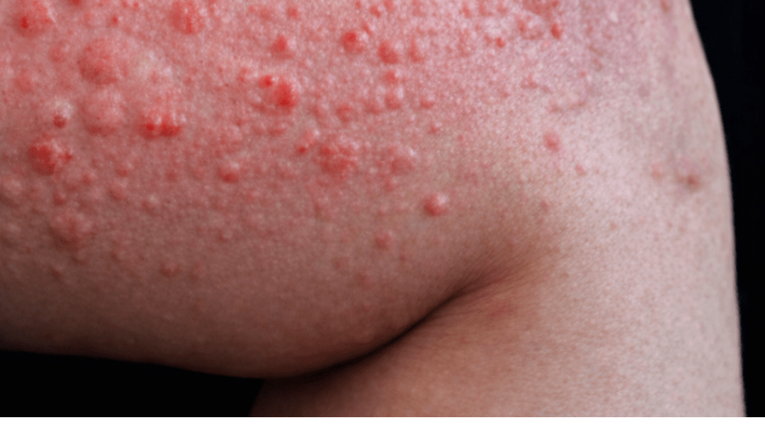 Why Do Hives Suddenly Appear on Your Skin? Surprising Triggers You May Not Expect – Health