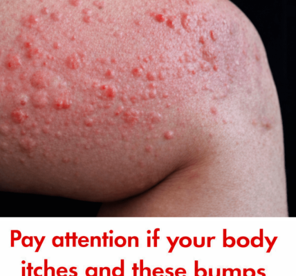 Why Do Hives Suddenly Appear on Your Skin? Surprising Triggers You May Not Expect – Health