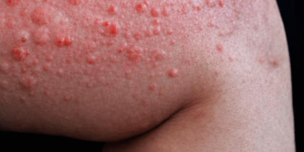 Why Do Hives Suddenly Appear on Your Skin? Surprising Triggers You May Not Expect – Health