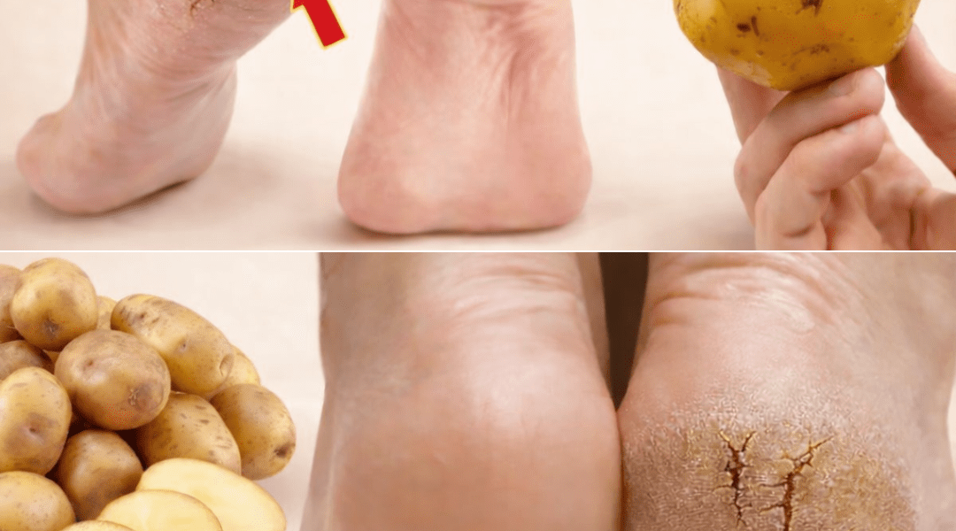 Just ONE Potato Can Help You Say Goodbye to Cracked Heels for Good – Health