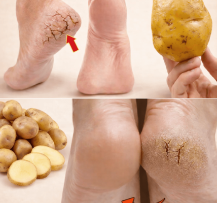 Just ONE Potato Can Help You Say Goodbye to Cracked Heels for Good – Health