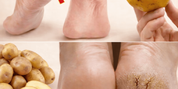 Just ONE Potato Can Help You Say Goodbye to Cracked Heels for Good – Health