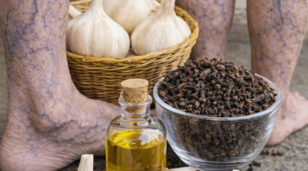 Can Simple Kitchen Ingredients Really Help Ease Leg Pain, Stiffness, and Visible Veins?
