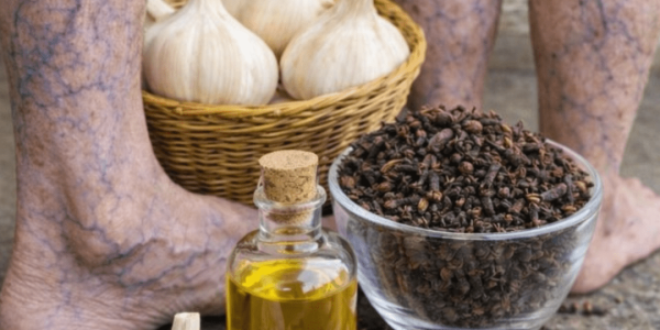 Can Simple Kitchen Ingredients Really Help Ease Leg Pain, Stiffness, and Visible Veins? Can Simple Kitchen Ingredients Really Help Ease Leg Pain, Stiffness, and Visible Veins?