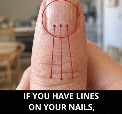 Lines on Your Fingernails: What They Might Reveal About Your Health Lines on Your Fingernails: What They Might Reveal About Your Health