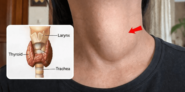 Your Thyroid Is Begging You to Stop Eating These 6 Foods Immediately!