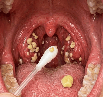Bad Breath That Won’t Go Away? Could Tonsil Stones Be the Hidden Cause