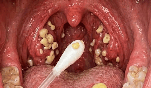 Bad Breath That Won’t Go Away? Could Tonsil Stones Be the Hidden Cause Bad Breath That Won’t Go Away? Could Tonsil Stones Be the Hidden Cause