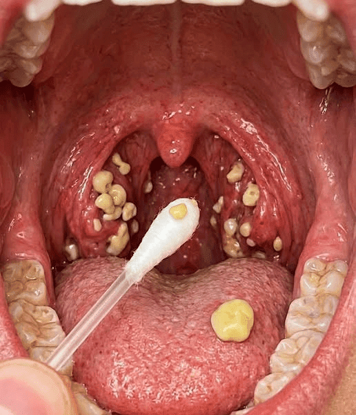 Bad Breath That Won’t Go Away? Could Tonsil Stones Be the Hidden Cause