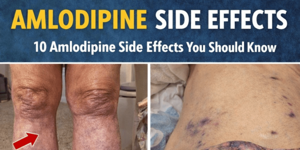 10 Common Amlodipine Side Effects You Should Know About If You Take This Popular Blood Pressure Medication