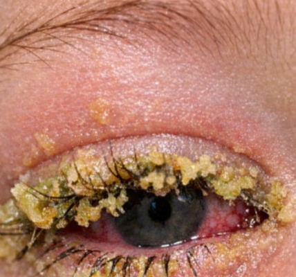 Toddler’s Eye Glued Shut With Yellow Gunk? Safe Ways to Clean It at Home