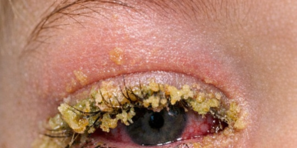 Toddler’s Eye Glued Shut With Yellow Gunk? Safe Ways to Clean It at Home