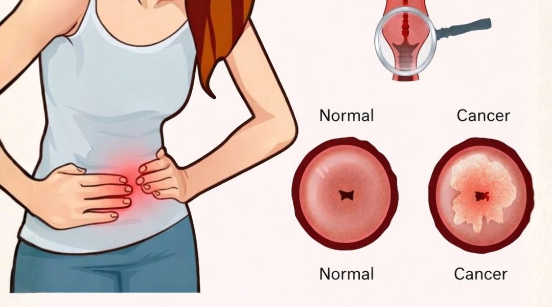 Cervical Cancer Symptoms You Should Never Ignore Cervical Cancer Symptoms You Should Never Ignore