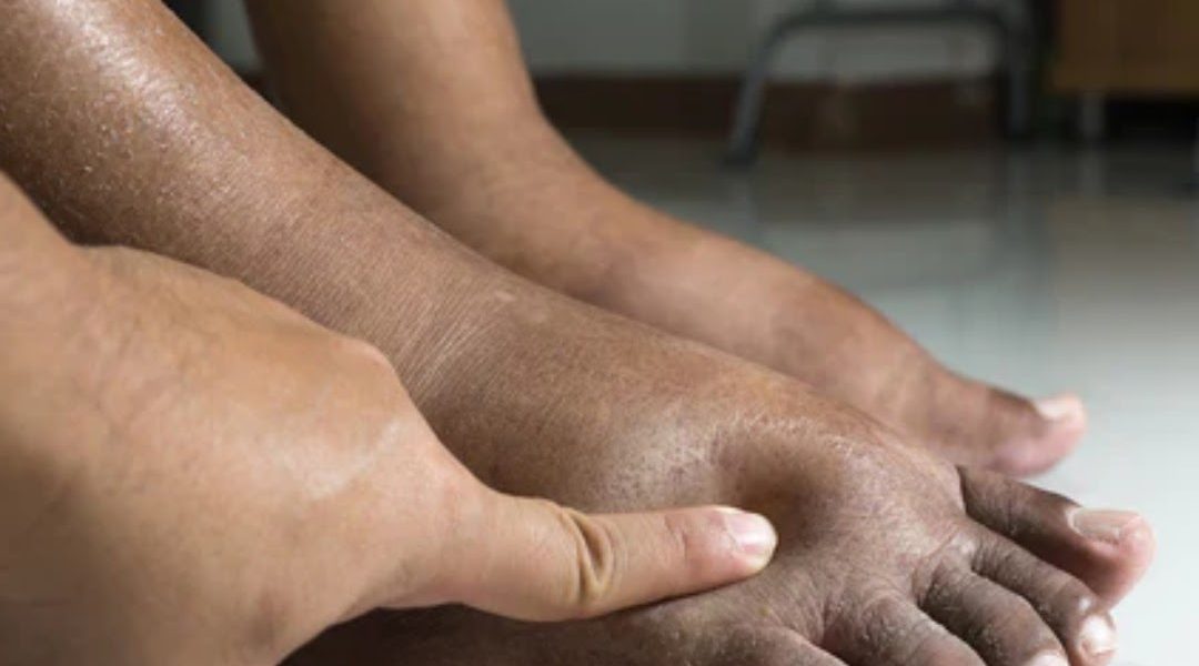 What Causes Swollen Feet & What To Do?