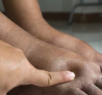 What Causes Swollen Feet & What To Do?