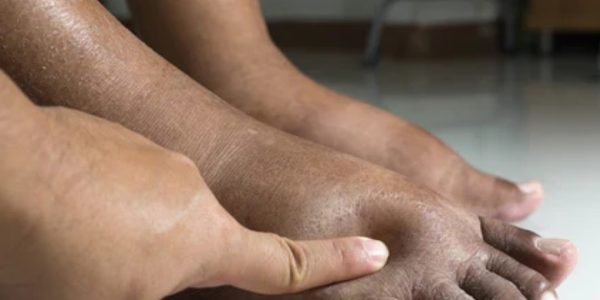 What Causes Swollen Feet & What To Do?