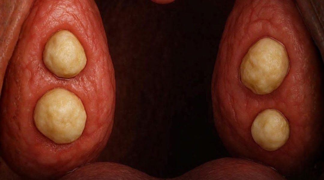 Why Do White “Smelly Stones” Form in the Mouth? (Tonsil Stones Explained) Why Do White “Smelly Stones” Form in the Mouth? (Tonsil Stones Explained)