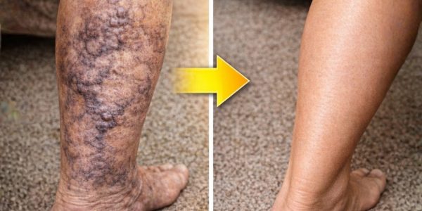 Why Blood Circulation in Your Legs Is More Important Than You Think