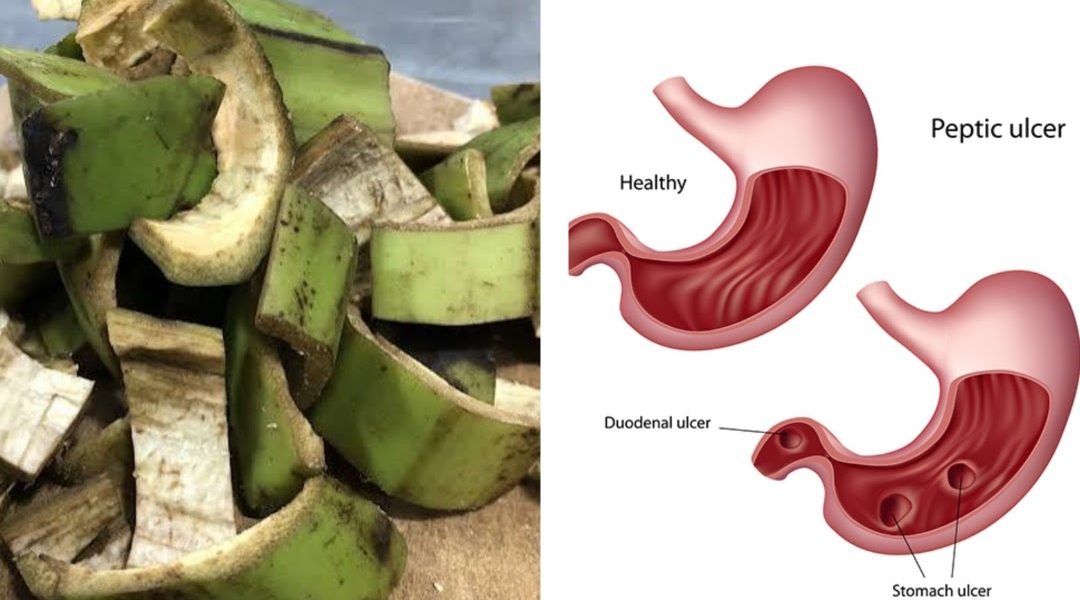 Natural Remedy for Stomach Ulcers & H. pylori: Plantain Peel Treatment Natural Remedy for Stomach Ulcers & H. pylori: Plantain Peel Treatment