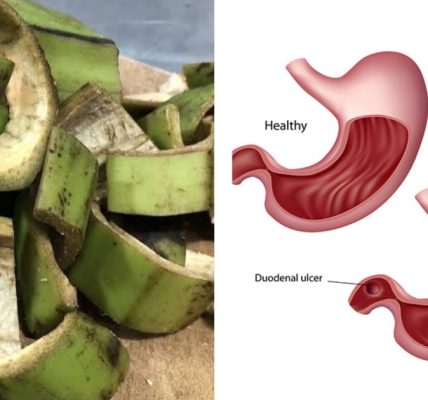 Natural Remedy for Stomach Ulcers & H. pylori: Plantain Peel Treatment Natural Remedy for Stomach Ulcers & H. pylori: Plantain Peel Treatment