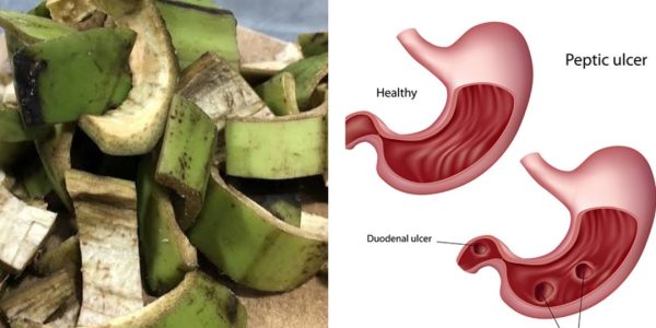 Natural Remedy for Stomach Ulcers & H. pylori: Plantain Peel Treatment Natural Remedy for Stomach Ulcers & H. pylori: Plantain Peel Treatment