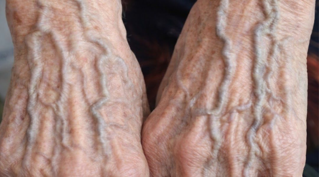 Bulging Veins …When They’re Harmless and When They Could Signal a Problem